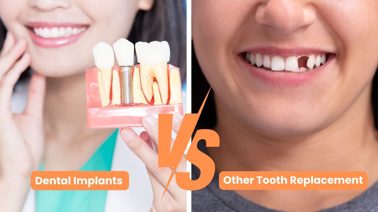 Benefits of Dental Implants vs. Other Tooth Replacement Options