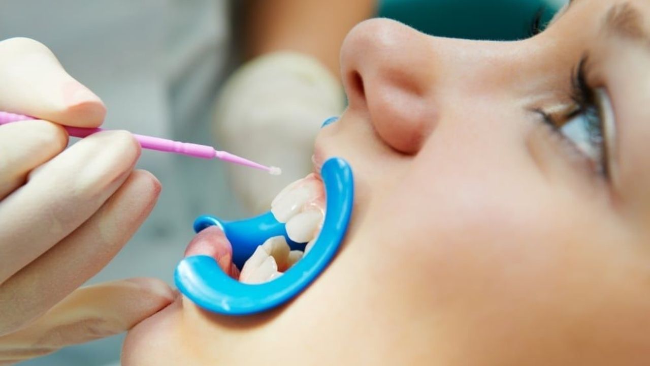 Fluoride application and dental sealants