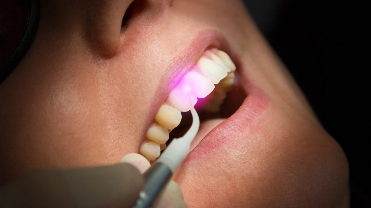 Laser Dental Treatment 