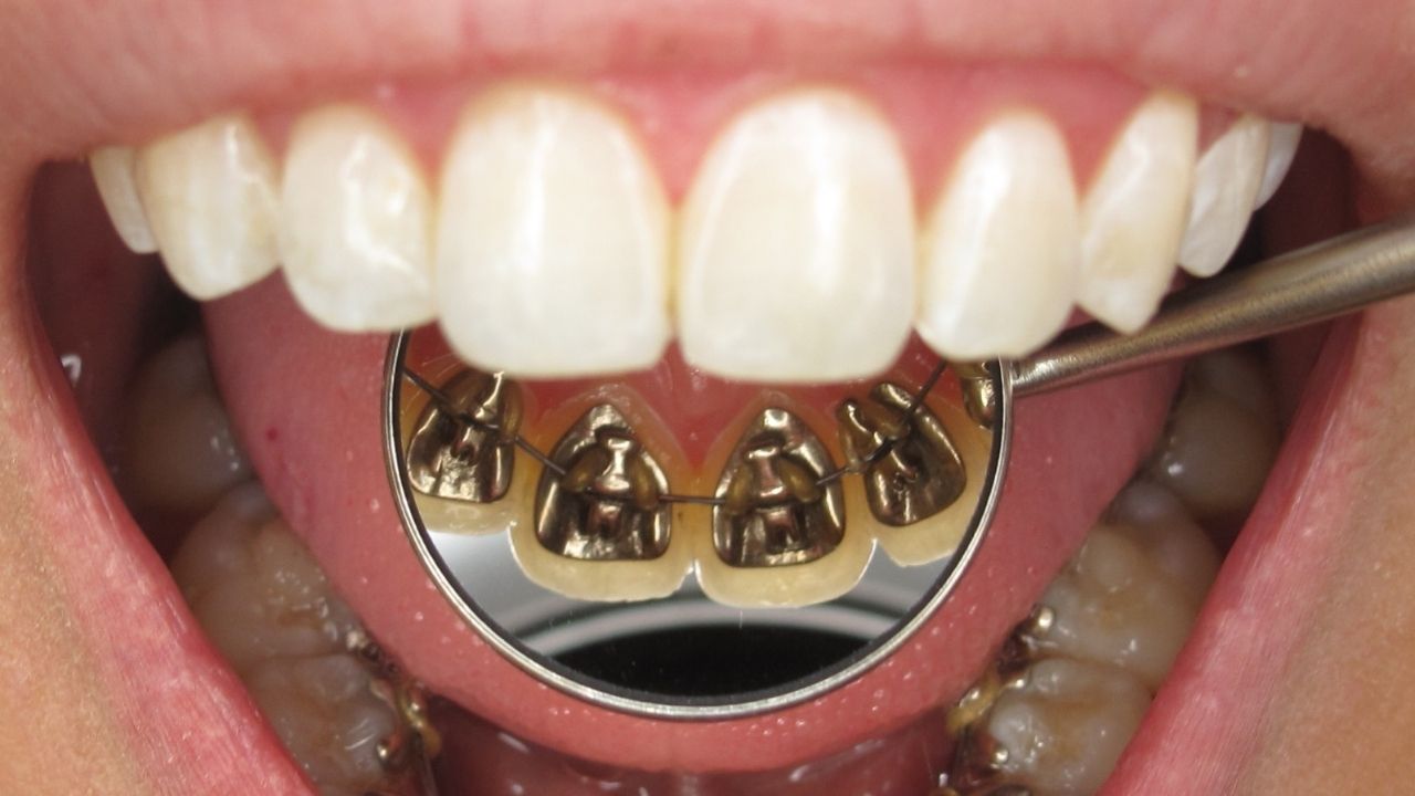 Lingual Braces Treatment 