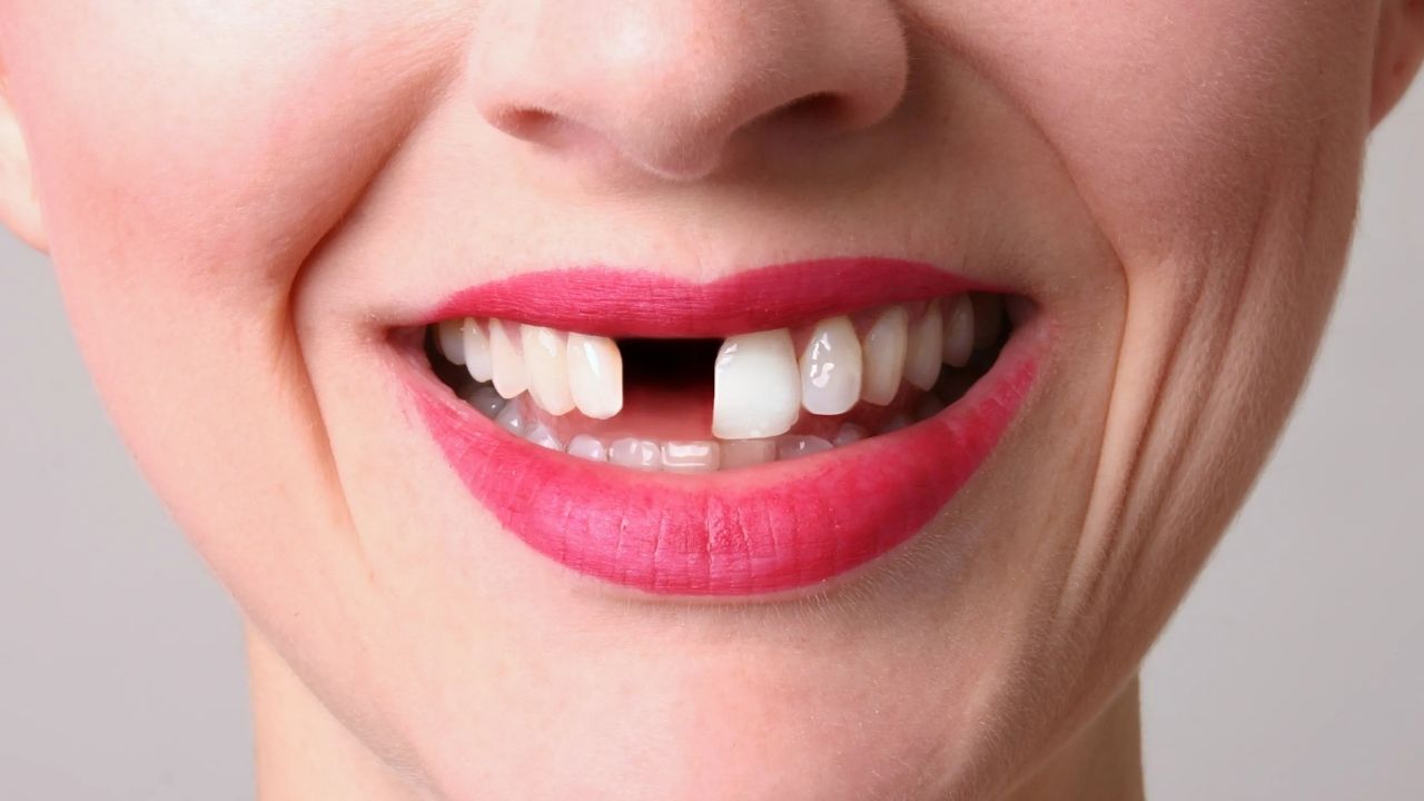 Missing Tooth Treatment 