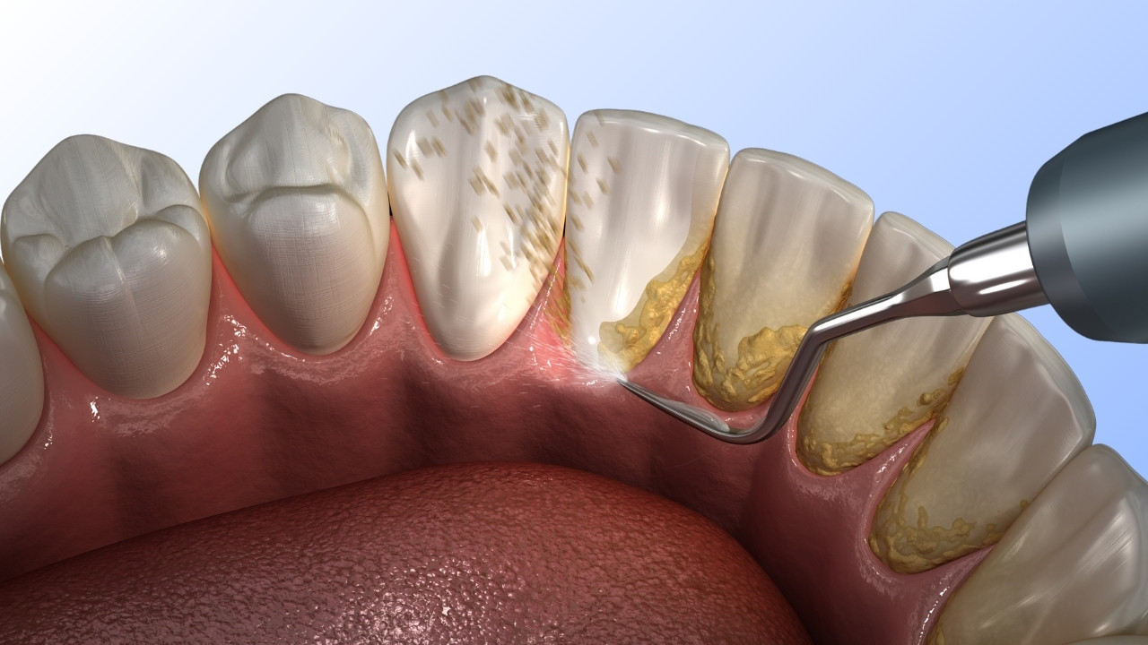 Teeth Cleaning 