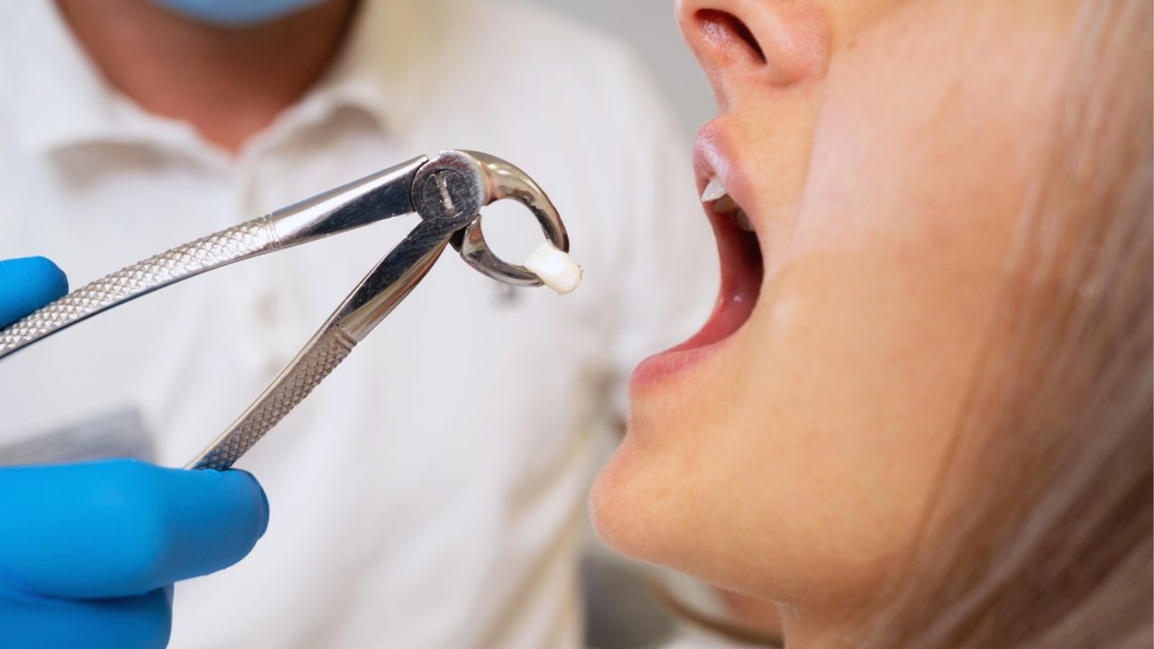 Tooth Extraction 